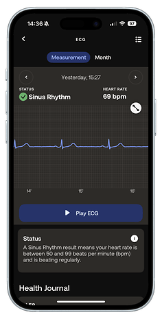 ECG reading on a smartphone showing sinus rhythm and heart rate of 69 bpm.
