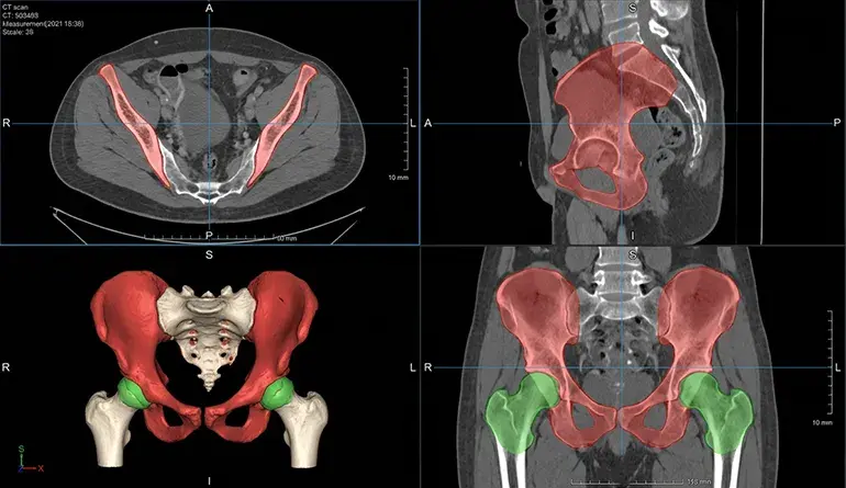 A Practical Guide to Bone Tissue Labeling and Annotation 3 ITK-SNAP